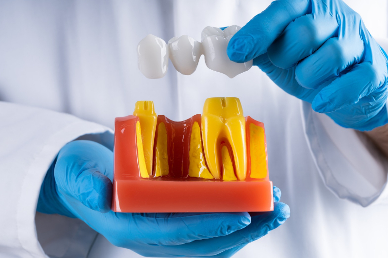 Dental Bridges in Westfield