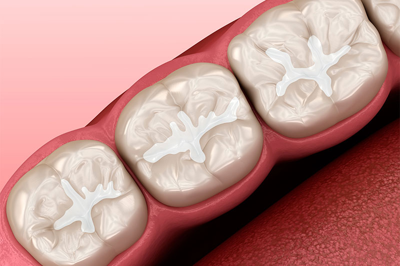 Dental Sealants Westfield