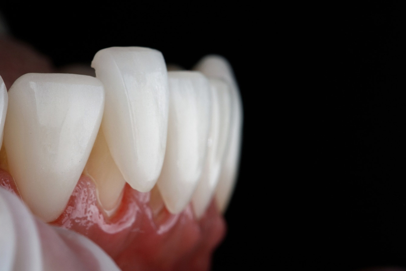 Porcelain Veneers Westfield