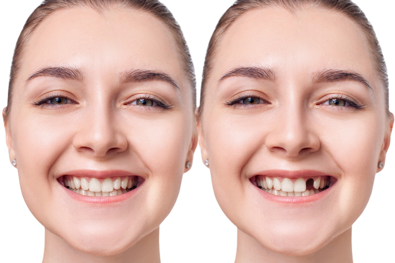 Tooth Replacement Westfield